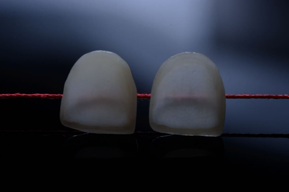 Dottori Mandelli | Faccette Dentali macro 1