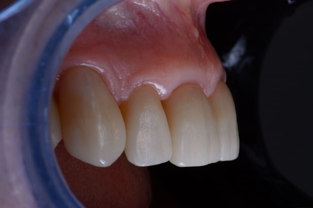 Dottori Mandelli | Faccette Dentali macro 8